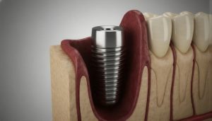 Уход За Имплантами После Установки